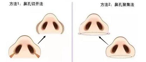 不同情况的鼻翼缩小方法有哪些