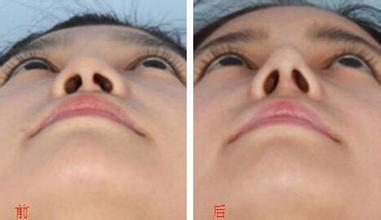 鼻翼宽大表现及矫正方法