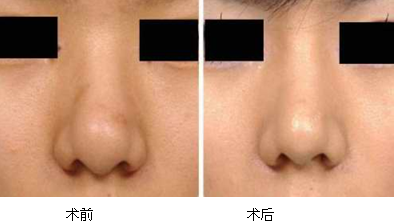 缩鼻头手术可以永久吗