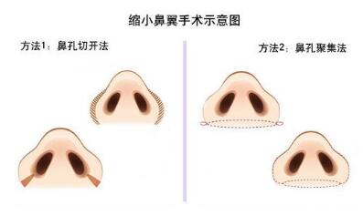 鼻翼塑形术后注意事项