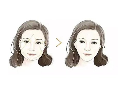 上海九院下颌角削骨怎么样