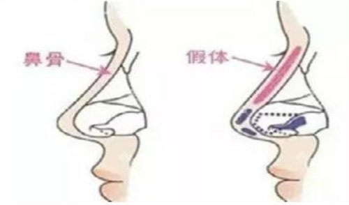 成都隆鼻整形医院排行榜完整介绍_口碑案例及手术价格费用明细