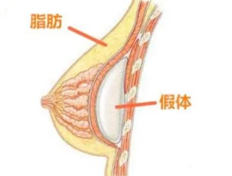自體脂肪隆胸是不是比假體隆胸好