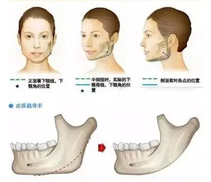 韩国下颌角整形医院排名榜权威盘点