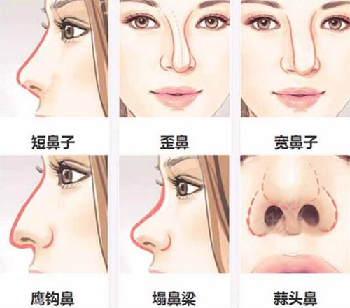 上海肋骨隆鼻鼻王名单公布