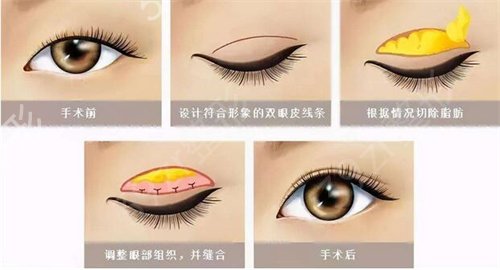 想割双眼皮