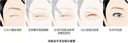 天津眼科医院整形科王小强双眼皮怎么样
