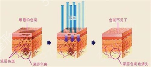 上海*祛斑比较好的医院排行榜