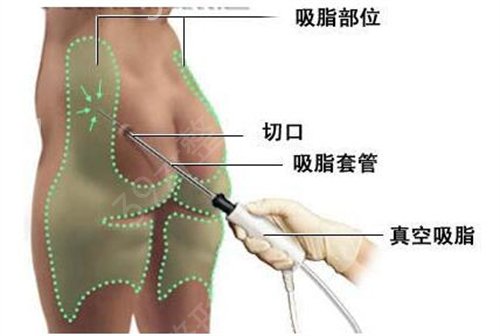 绵阳吸脂手术医院排名榜前四