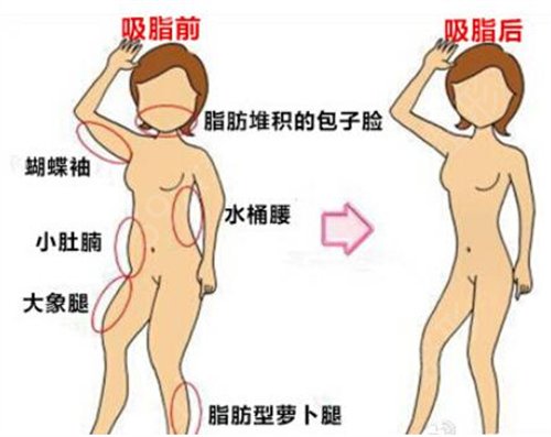 绵阳吸脂手术医院排名榜前四
