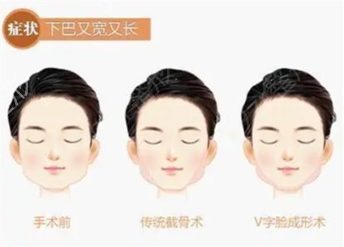 2022北京下颌骨磨骨整形医院排名表