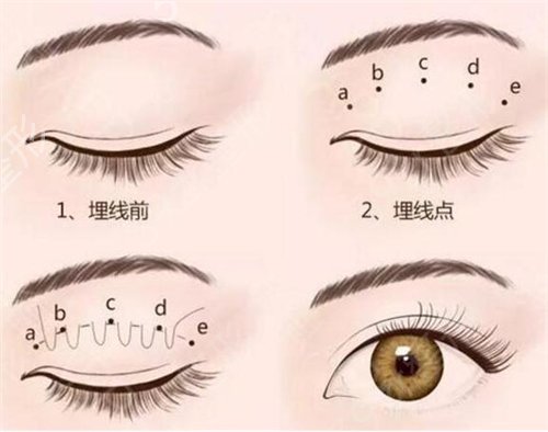 北京协和和301医院整形科做双眼皮哪个好