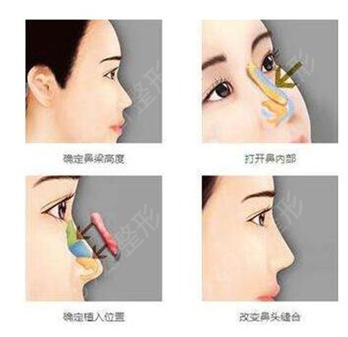 成都隆鼻医院哪个好