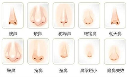 北京隆鼻整形医院排行榜前三参考_附协和医院隆鼻案例_价格查询