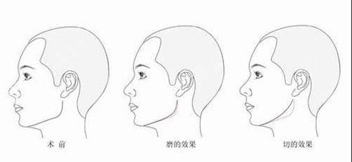 北京磨骨哪家医院好