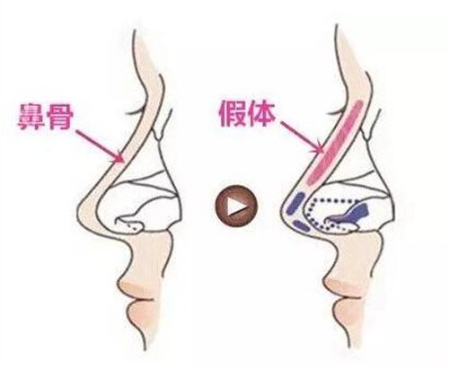 深圳鹏程美容做膨体隆鼻个人自述