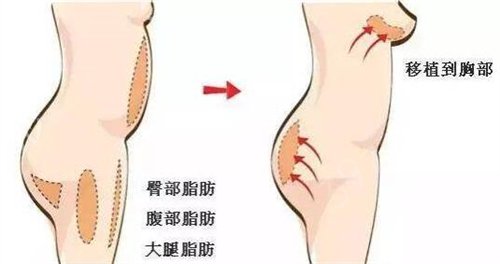 厦门隆胸好的医院除了华美、海峡还有脸博士