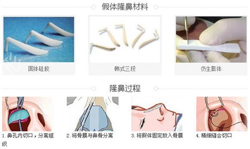 北京隆鼻整形医院排行榜前三参考_附协和医院隆鼻案例_价格查询