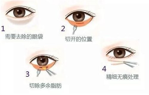 南京哪家医院去眼袋手术好