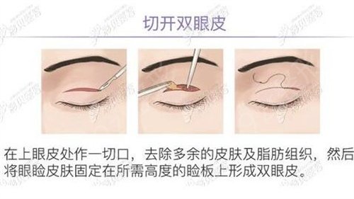 北京301医院和八大处整形科哪个双眼皮好
