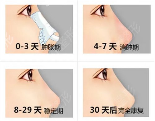 北京隆鼻手术哪家好