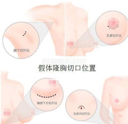 隆胸手术三甲医院哪家好