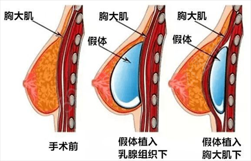 北京韩啸医疗美容医院专家排名_棉花糖隆胸案例_价格标准