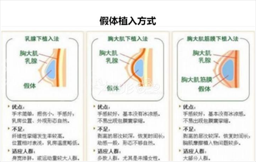 徐州正规隆胸假体取出医院_徐州二院美容整形科真人案例_价格表