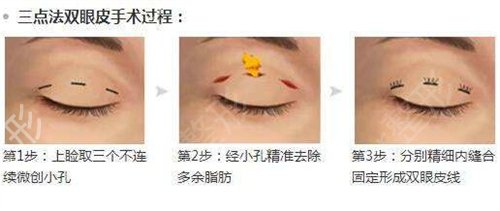 想割双眼皮