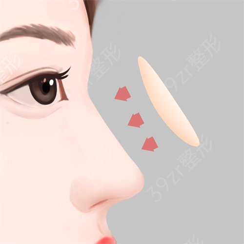 西安隆鼻有名的医生哪个好