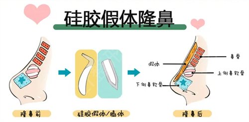 沈阳隆鼻医院排名榜公开_口碑哪家好