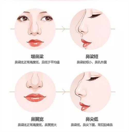 成都鼻部整形医院哪家好