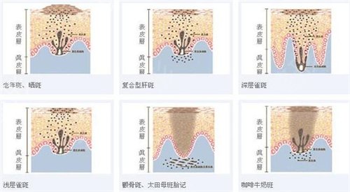 在重慶新時代整形做完皮膚激光祛斑