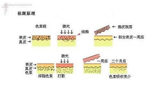 在重慶新時代整形做完皮膚激光祛斑
