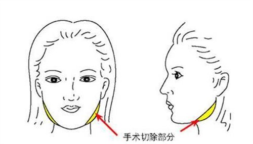 上海磨骨厉害的医生谁技术更牛