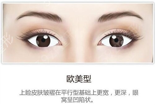 成都三甲医院（华西医院）双眼皮价格分享_医生整形案例推荐