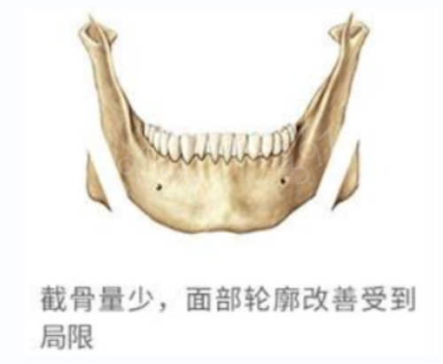 上海磨骨哪里好