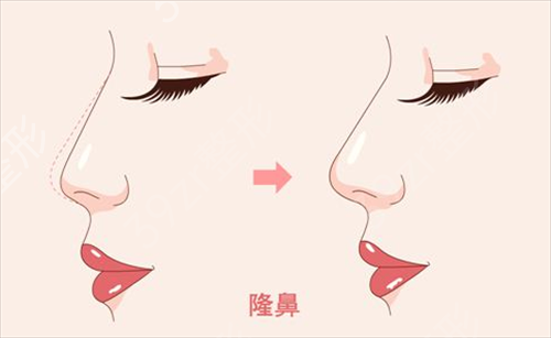 四川友谊医院整形科隆鼻怎么样