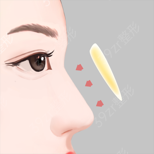 廣州韓致做的自體軟骨隆鼻