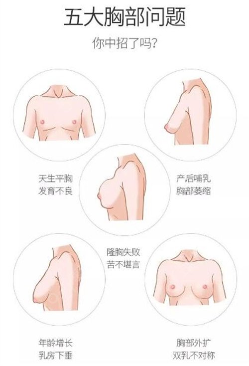 深圳哪家公立医院（深圳北大）有隆胸手术