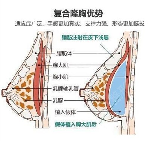 北京韩啸医疗美容医院专家排名_棉花糖隆胸案例_价格标准