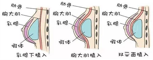 徐州正规隆胸假体取出医院_徐州二院美容整形科真人案例_价格表