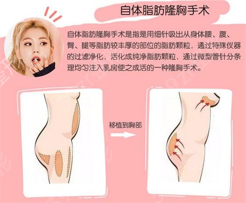 北京自体脂肪丰胸好医院是哪家