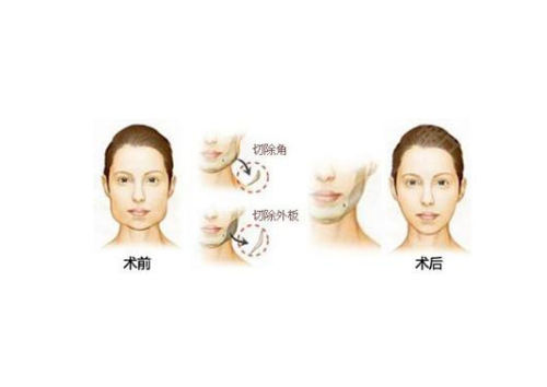 上海哪家医院做磨骨手术好