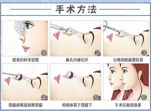 北医三院整形科和上海九院隆鼻哪个好