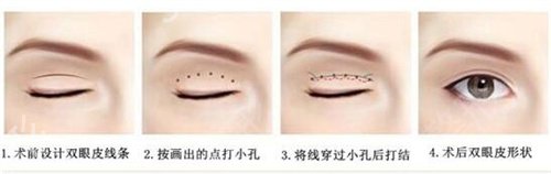 深圳哪里做双眼皮比较好