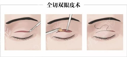 武汉协和医院整形科做双眼皮怎么样