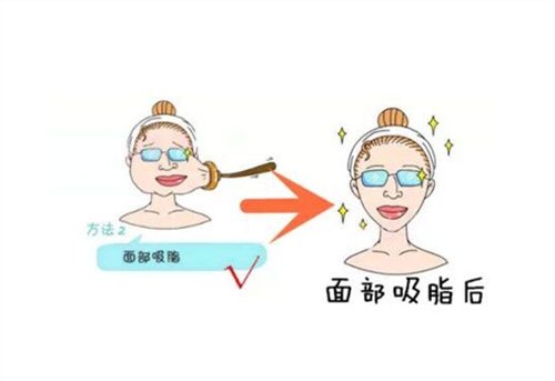 偶然去到北京艺美做脸部吸脂