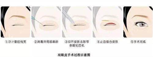 延安医院整形科哪个医生做双眼皮修复好