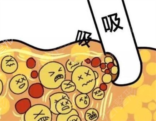 成都做吸脂手术哪家医院好